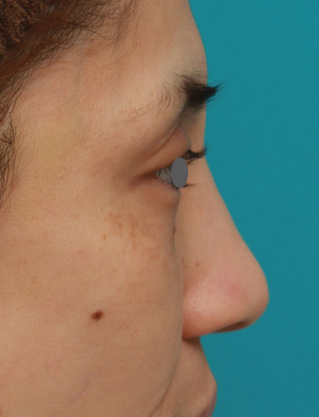 隆鼻注射（ヒアルロン酸注射）,患者様の希望で眉間から鼻根部にかけてヒアルロン酸を注射し、ギリシャ人のようになった症例写真,1ヶ月後,mainpic_ryubi2028i.jpg