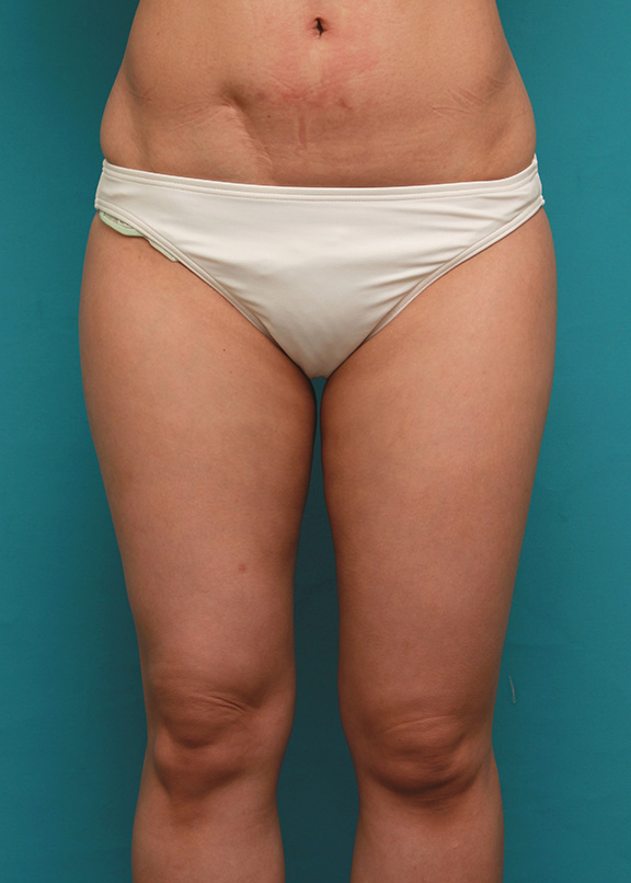 イタリアン・メソシェイプ（イタリアンメソセラピー）・脂肪溶解注射で太もも全体を一回り細くした40代女性の症例写真,After（6回注射後2ヶ月）,ba_meso038_a01.jpg