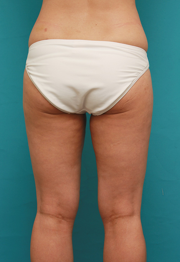 イタリアン・メソシェイプ（イタリアンメソセラピー）・脂肪溶解注射,イタリアン・メソシェイプ（イタリアンメソセラピー）・脂肪溶解注射で太もも全体を一回り細くした40代女性の症例写真,After（6回注射後2ヶ月）,ba_meso038_b05.jpg