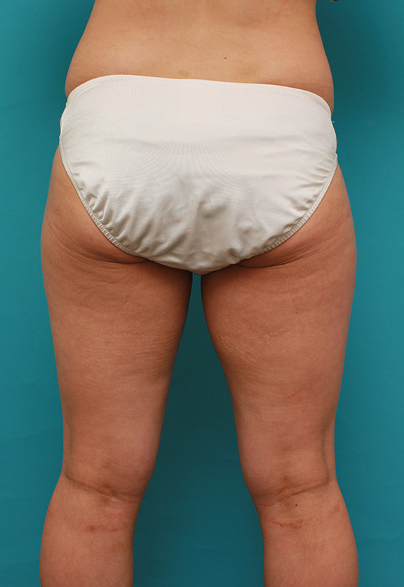 イタリアン・メソシェイプ（イタリアンメソセラピー）・脂肪溶解注射,イタリアン・メソシェイプ（イタリアンメソセラピー）・脂肪溶解注射で太もも全体を一回り細くした40代女性の症例写真,Before,ba_meso038_b05.jpg