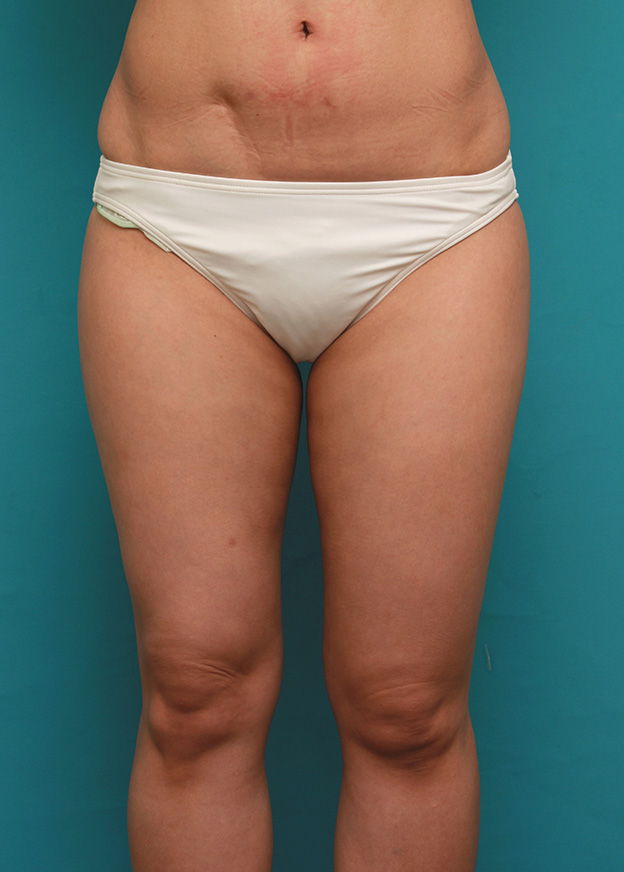 症例写真,イタリアン・メソシェイプ（イタリアンメソセラピー）・脂肪溶解注射で太もも全体を一回り細くした40代女性の症例写真,6回注射後2ヶ月,mainpic_meso038d.jpg
