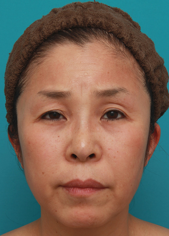 上まぶたたるみ取り,こめかみリフト,こめかみリフトと上まぶたたるみ取り手術で顔の上半分をエイジングケアした50代女性の症例写真,Before,ba_komekamilift003_b01.jpg