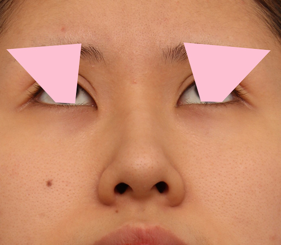 鼻翼縮小（小鼻縮小）,鼻の穴の内側から外側の途中にかけて切除するデザインで小鼻縮小した症例写真,After（6ヶ月後）,ba_biyoku042_b02.jpg
