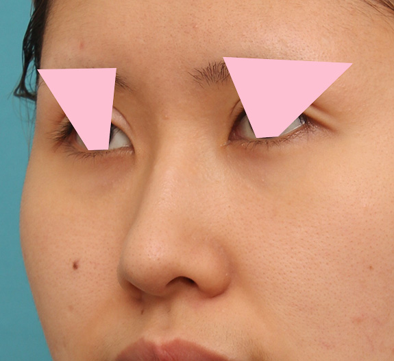 鼻翼縮小（小鼻縮小）,鼻の穴の内側から外側の途中にかけて切除するデザインで小鼻縮小した症例写真,After（6ヶ月後）,ba_biyoku042_b03.jpg
