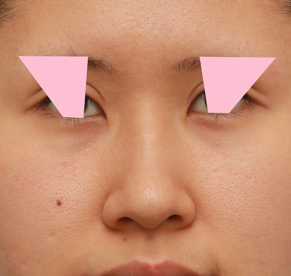鼻の穴の内側から外側の途中にかけて切除するデザインで小鼻縮小した症例写真,Before,ba_biyoku042_b01.jpg