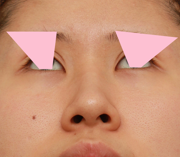 鼻翼縮小（小鼻縮小）,鼻の穴の内側から外側の途中にかけて切除するデザインで小鼻縮小した症例写真,Before,ba_biyoku042_b02.jpg