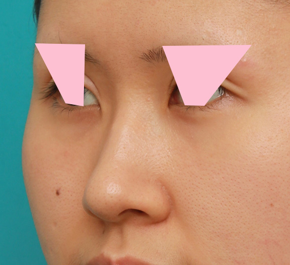 症例写真,鼻の穴の内側から外側の途中にかけて切除するデザインで小鼻縮小した症例写真,Before,ba_biyoku042_b03.jpg