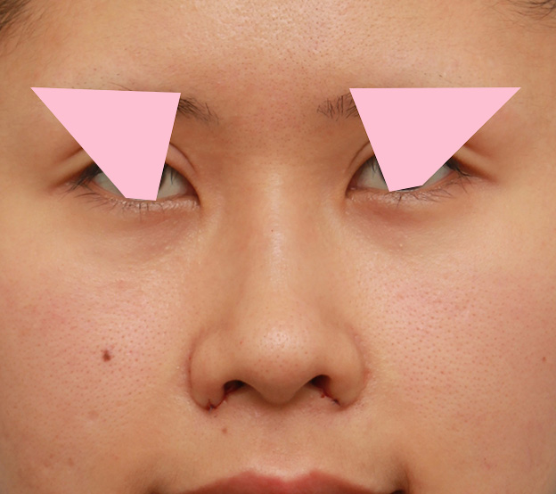 鼻翼縮小（小鼻縮小）,鼻の穴の内側から外側の途中にかけて切除するデザインで小鼻縮小した症例写真,手術直後,mainpic_biyoku042b.jpg