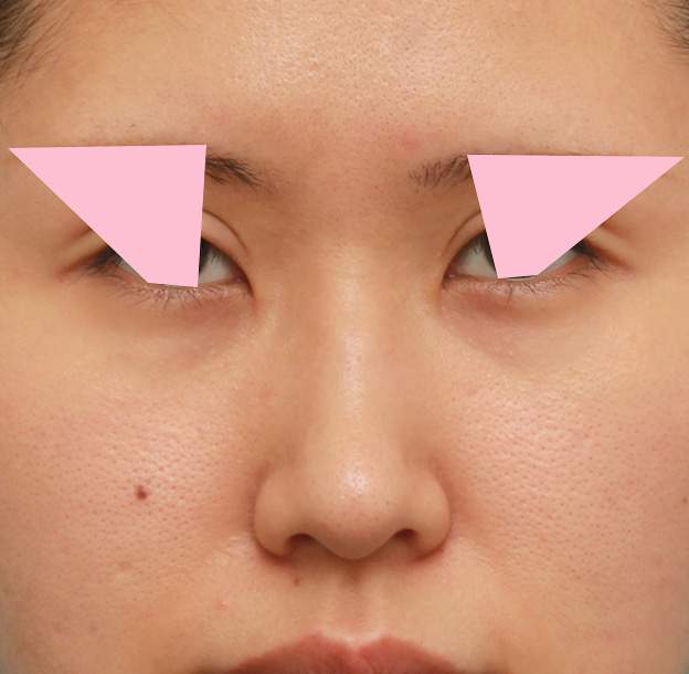 鼻翼縮小（小鼻縮小）,鼻の穴の内側から外側の途中にかけて切除するデザインで小鼻縮小した症例写真,6ヶ月後,mainpic_biyoku042d.jpg