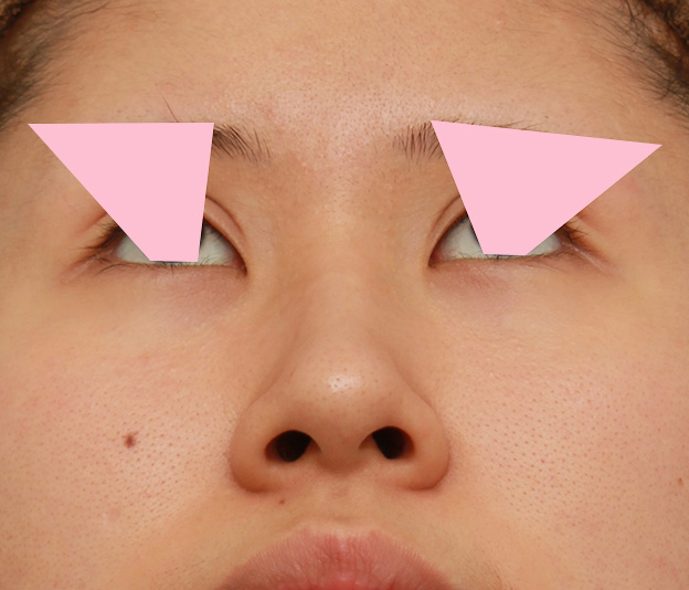 鼻翼縮小（小鼻縮小）,鼻の穴の内側から外側の途中にかけて切除するデザインで小鼻縮小した症例写真,手術前,mainpic_biyoku042e.jpg