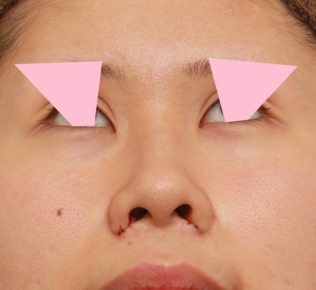 鼻翼縮小（小鼻縮小）,鼻の穴の内側から外側の途中にかけて切除するデザインで小鼻縮小した症例写真,手術直後,mainpic_biyoku042f.jpg
