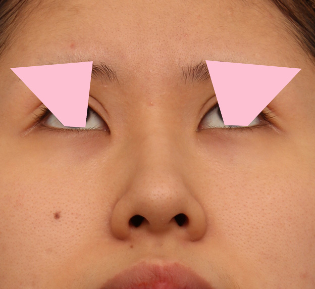 鼻翼縮小（小鼻縮小）,鼻の穴の内側から外側の途中にかけて切除するデザインで小鼻縮小した症例写真,6ヶ月後,mainpic_biyoku042h.jpg