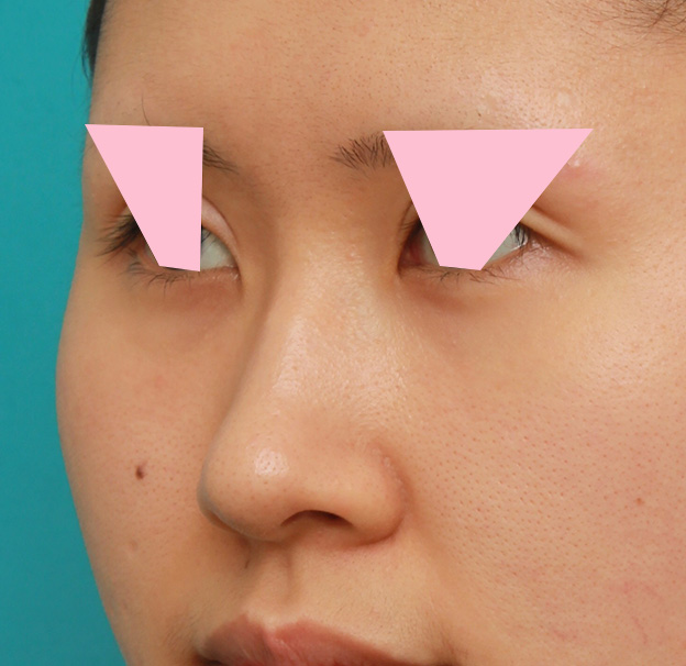 鼻翼縮小（小鼻縮小）,鼻の穴の内側から外側の途中にかけて切除するデザインで小鼻縮小した症例写真,手術前,mainpic_biyoku042i.jpg