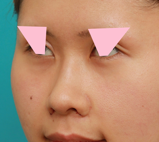 鼻翼縮小（小鼻縮小）,鼻の穴の内側から外側の途中にかけて切除するデザインで小鼻縮小した症例写真,手術直後,mainpic_biyoku042j.jpg