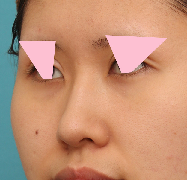鼻翼縮小（小鼻縮小）,鼻の穴の内側から外側の途中にかけて切除するデザインで小鼻縮小した症例写真,6ヶ月後,mainpic_biyoku042l.jpg
