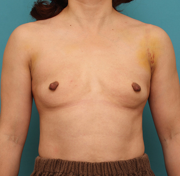 他院で受けた手術の修正（豊胸・バスト・乳首）,被膜（カプセル）拘縮を起こした豊胸シリコンプロテーゼを除去した症例写真,After（1週間後）,ba_prosthesis_removal004_b01.jpg