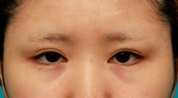 他院で受けた手術の修正（二重まぶた・目もと）,他院で目頭切開を受けた後、蒙古襞形成で修正手術した症例写真,手術前,mainpic_hida008a.jpg