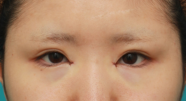 他院で受けた手術の修正（二重まぶた・目もと）,他院で目頭切開を受けた後、蒙古襞形成で修正手術した症例写真,手術直後,mainpic_hida008b.jpg