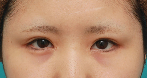 他院で受けた手術の修正（二重まぶた・目もと）,他院で目頭切開を受けた後、蒙古襞形成で修正手術した症例写真,3週間後,mainpic_hida008d.jpg