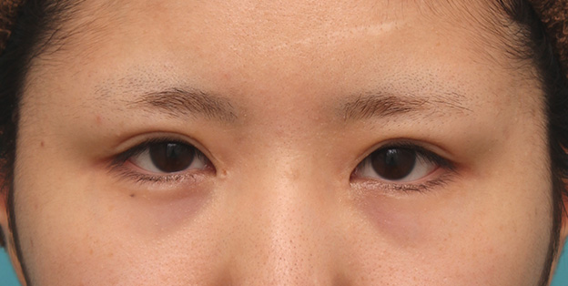 他院で受けた手術の修正（二重まぶた・目もと）,他院で目頭切開を受けた後、蒙古襞形成で修正手術した症例写真,3ヶ月後,mainpic_hida008e.jpg