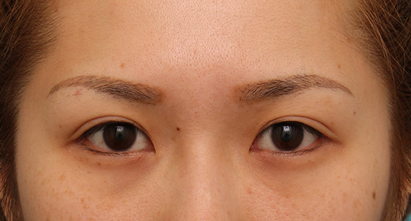 目尻切開,目尻切開で目を外側に大きくした20代女性の症例写真,After（6ヶ月後）,ba_mejiri015_b01.jpg