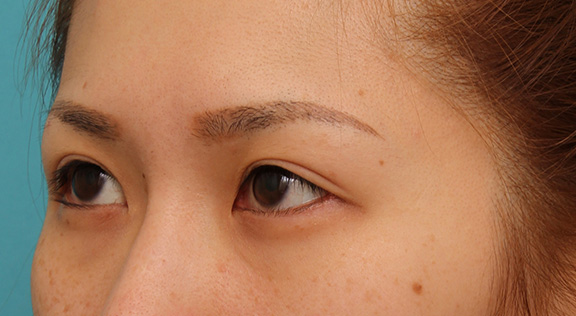 目尻切開,目尻切開で目を外側に大きくした20代女性の症例写真,After（6ヶ月後）,ba_mejiri015_b02.jpg