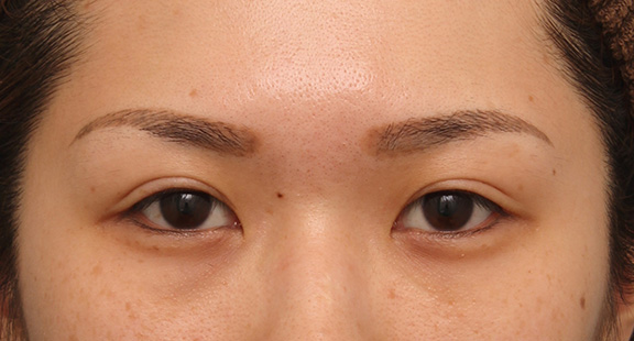 目尻切開,目尻切開で目を外側に大きくした20代女性の症例写真,Before,ba_mejiri015_b01.jpg