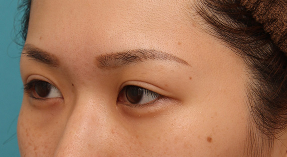 目尻切開,目尻切開で目を外側に大きくした20代女性の症例写真,Before,ba_mejiri015_b02.jpg
