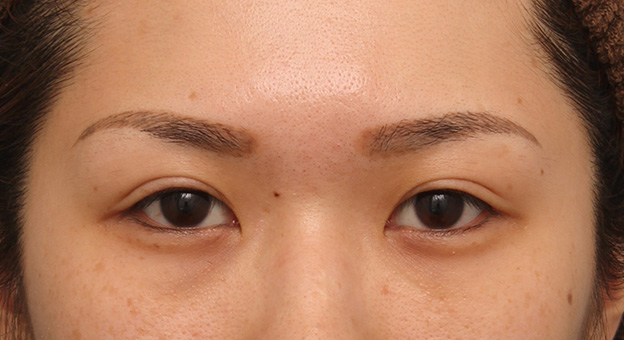 症例写真,目尻切開で目を外側に大きくした20代女性の症例写真,手術前,mainpic_mejiri015a.jpg