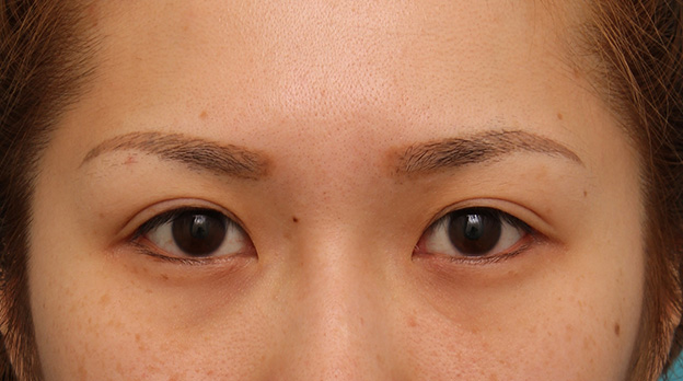 目尻切開,目尻切開で目を外側に大きくした20代女性の症例写真,6ヶ月後,mainpic_mejiri015e.jpg