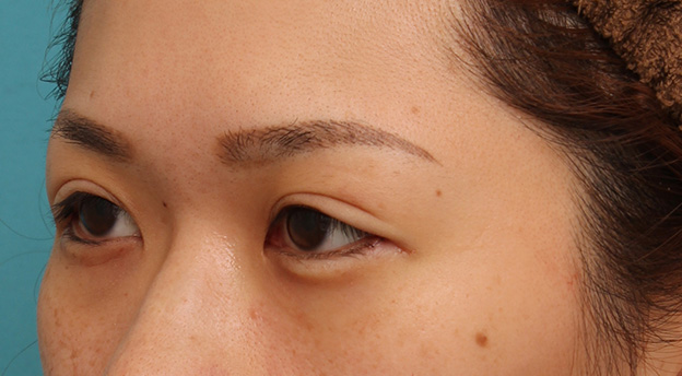 症例写真,目尻切開で目を外側に大きくした20代女性の症例写真,手術直後,mainpic_mejiri015g.jpg