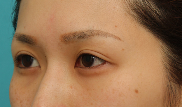 目尻切開,目尻切開で目を外側に大きくした20代女性の症例写真,1ヶ月後,mainpic_mejiri015i.jpg