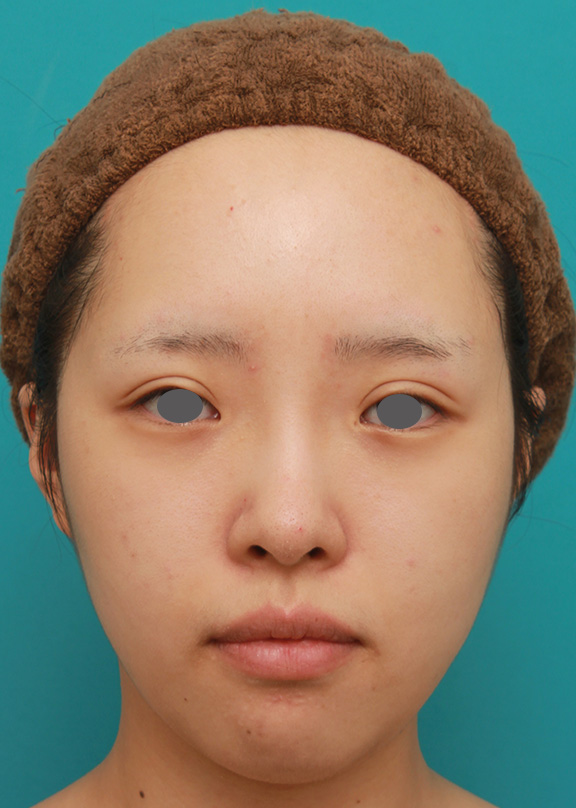 顔の脂肪溶解注射をした後、ボツリヌストキシン注射（エラ、プチ小顔術）をし、更に小顔になった20代女性の症例写真,After（注射後1ヶ月）,ba_botox_puchi028_a01.jpg