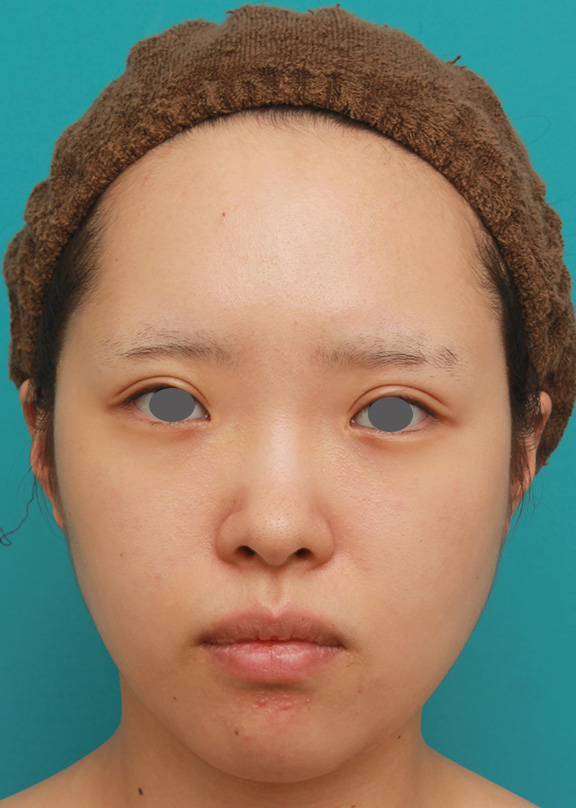顔の脂肪溶解注射をした後、ボツリヌストキシン注射（エラ、プチ小顔術）をし、更に小顔になった20代女性の症例写真,Before,ba_botox_puchi028_b01.jpg