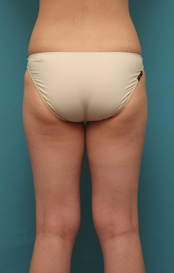 症例写真,太ももをイタリアン・メソシェイプ（イタリアンメソセラピー）・脂肪溶解注射で細くした20代女性の症例写真,After（1クール治療後）,ba_meso039_b02.jpg