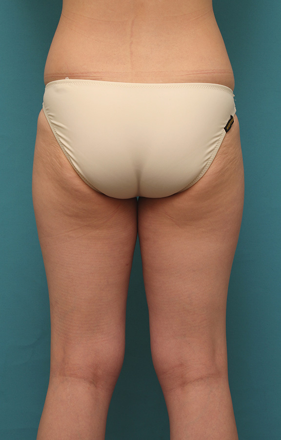 イタリアン・メソシェイプ（イタリアンメソセラピー）・脂肪溶解注射,太ももをイタリアン・メソシェイプ（イタリアンメソセラピー）・脂肪溶解注射で細くした20代女性の症例写真,Before,ba_meso039_b02.jpg