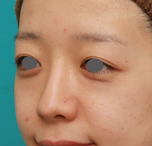 鼻翼縮小（小鼻縮小）,鼻シリコンプロテーゼ＋鼻先の耳介軟骨移植＋小鼻縮小の症例写真,After（7ヶ月後）,ba_ryubi1041_b02.jpg