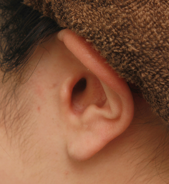 鼻翼縮小（小鼻縮小）,鼻シリコンプロテーゼ＋鼻先の耳介軟骨移植＋小鼻縮小の症例写真,After（7ヶ月後）,ba_ryubi1041_b03.jpg