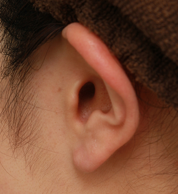 鼻翼縮小（小鼻縮小）,鼻シリコンプロテーゼ＋鼻先の耳介軟骨移植＋小鼻縮小の症例写真,Before,ba_ryubi1041_b03.jpg