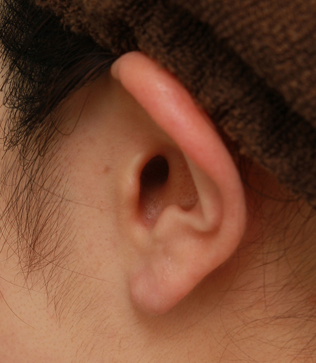 隆鼻術（シリコンプロテーゼ）,鼻シリコンプロテーゼ＋鼻先の耳介軟骨移植＋小鼻縮小の症例写真,手術前,mainpic_ryubi1041e.jpg