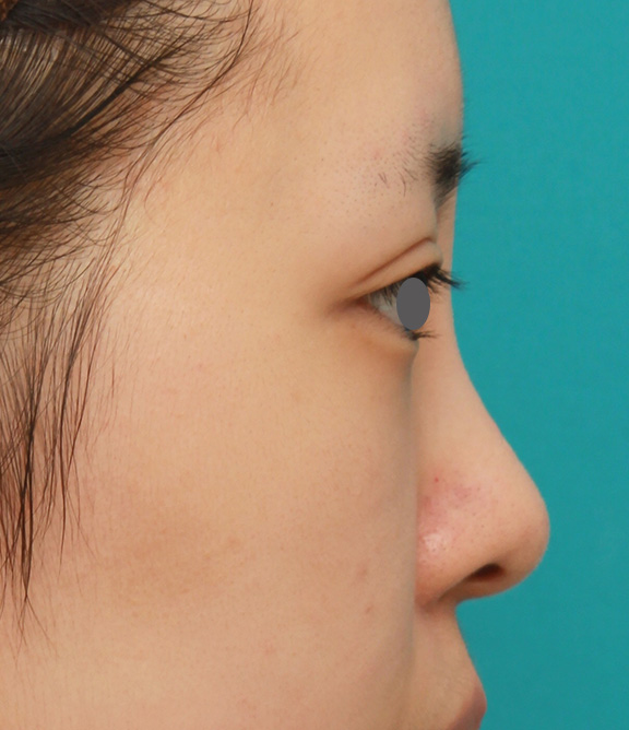 隆鼻術（シリコンプロテーゼ）,のっぺりした平らな顔に3.5mmのI型シリコンプロテーゼを入れ、自然に鼻筋を通した症例写真,After（6ヶ月後）,ba_ryubi1042_b03.jpg