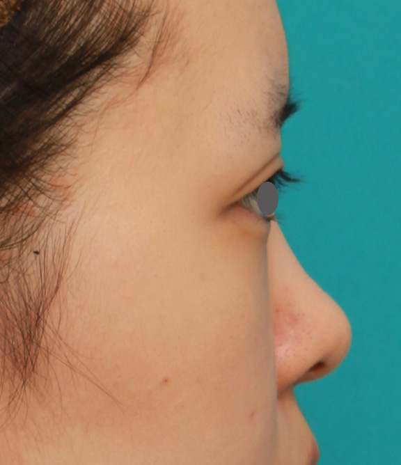隆鼻術（シリコンプロテーゼ）,のっぺりした平らな顔に3.5mmのI型シリコンプロテーゼを入れ、自然に鼻筋を通した症例写真,Before,ba_ryubi1042_b03.jpg