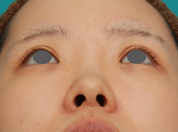 隆鼻術（シリコンプロテーゼ）,のっぺりした平らな顔に3.5mmのI型シリコンプロテーゼを入れ、自然に鼻筋を通した症例写真,Before,ba_ryubi1042_b04.jpg