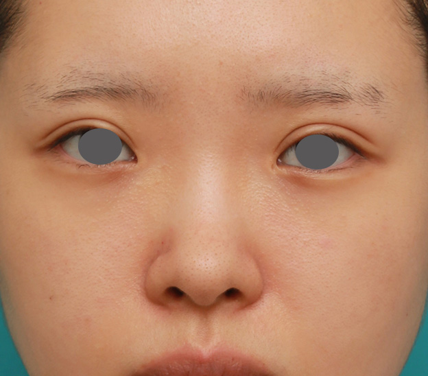 隆鼻術（シリコンプロテーゼ）,のっぺりした平らな顔に3.5mmのI型シリコンプロテーゼを入れ、自然に鼻筋を通した症例写真,手術前,mainpic_ryubi1042a.jpg