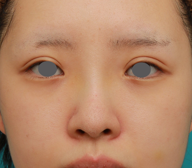 隆鼻術（シリコンプロテーゼ）,のっぺりした平らな顔に3.5mmのI型シリコンプロテーゼを入れ、自然に鼻筋を通した症例写真,6日後,mainpic_ryubi1042c.jpg