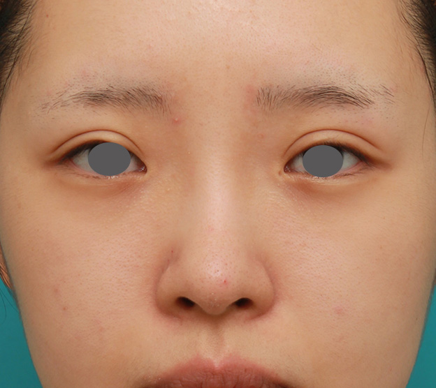 隆鼻術（シリコンプロテーゼ）,のっぺりした平らな顔に3.5mmのI型シリコンプロテーゼを入れ、自然に鼻筋を通した症例写真,6ヶ月後,mainpic_ryubi1042d.jpg