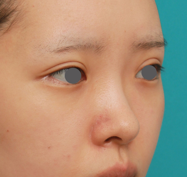 隆鼻術（シリコンプロテーゼ）,のっぺりした平らな顔に3.5mmのI型シリコンプロテーゼを入れ、自然に鼻筋を通した症例写真,手術前,mainpic_ryubi1042e.jpg