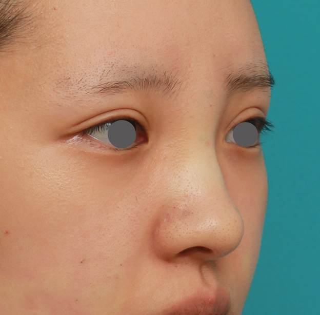 隆鼻術（シリコンプロテーゼ）,のっぺりした平らな顔に3.5mmのI型シリコンプロテーゼを入れ、自然に鼻筋を通した症例写真,手術直後,mainpic_ryubi1042f.jpg