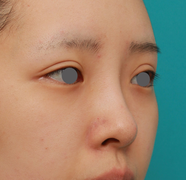 隆鼻術（シリコンプロテーゼ）,のっぺりした平らな顔に3.5mmのI型シリコンプロテーゼを入れ、自然に鼻筋を通した症例写真,6日後,mainpic_ryubi1042g.jpg
