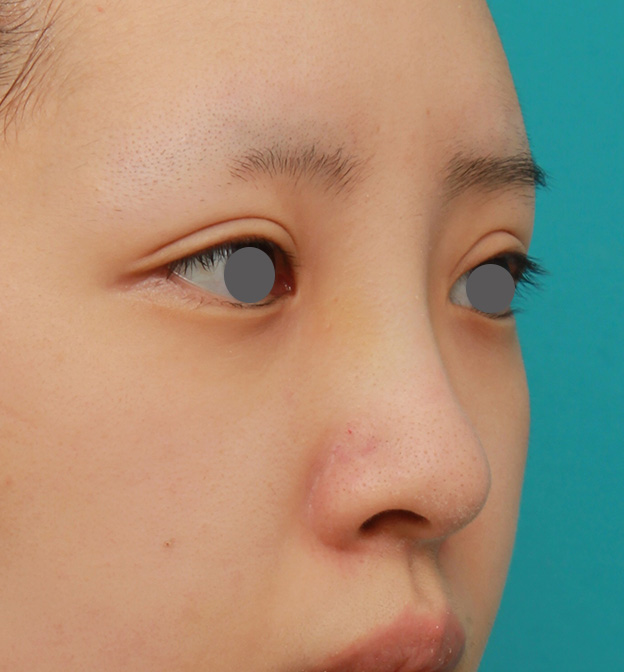 隆鼻術（シリコンプロテーゼ）,のっぺりした平らな顔に3.5mmのI型シリコンプロテーゼを入れ、自然に鼻筋を通した症例写真,6ヶ月後,mainpic_ryubi1042h.jpg